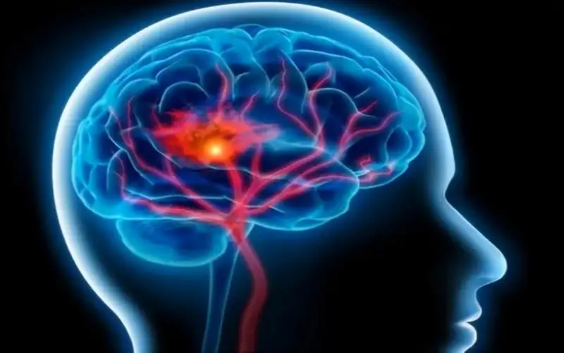 اكتشاف يساعد في علاج السكتة الدماغية