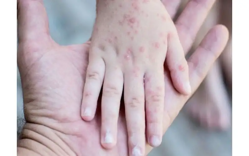 الجدل يجبر الصحة على تأجيل مطعوم