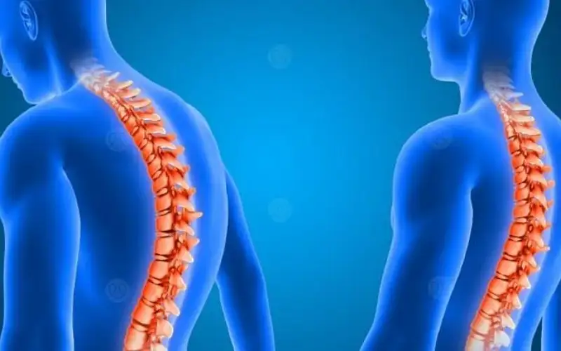 أسباب ومضاعفات فرط التحدب المرتبط بالعمر