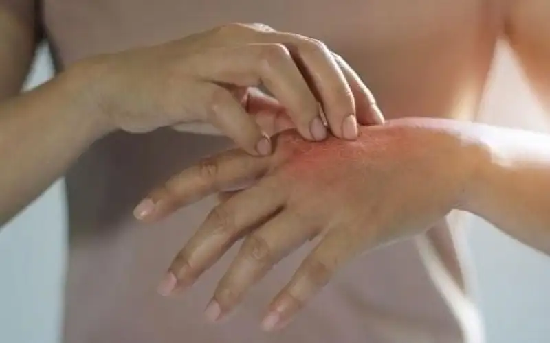 وداعا للأكزيما؟.. اكتشاف السبب الرئيسي للحكة