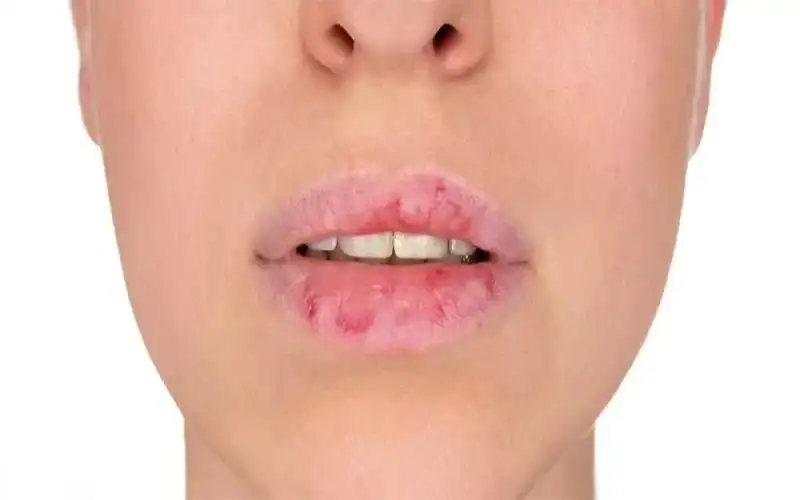 لماذا تتشقق الشفاه في الشتاء؟