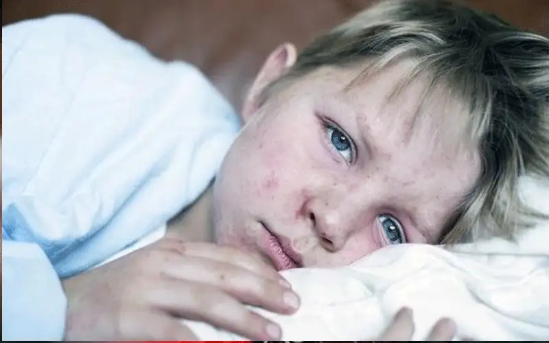 تحذير من عودة الحصبة بقوة إلى