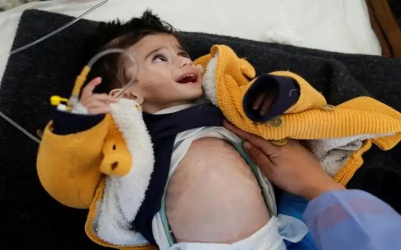 ارتفاع عدد الأطفال الشهداء بسبب سوء