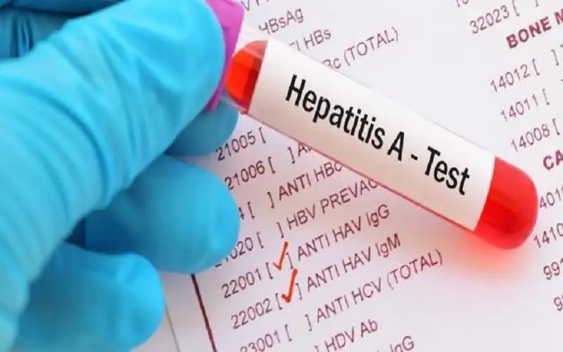 أنباء عن اصابات بالكبد الوبائي في