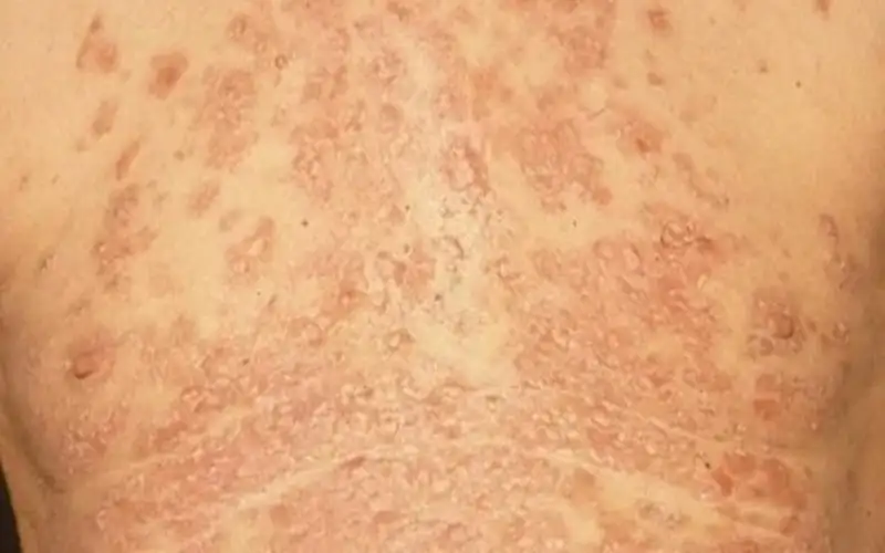 الفقاع .. مرض جلدي قد يهدد