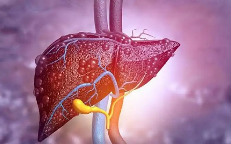 ما هو التهاب الكبد المناعي الذاتي؟