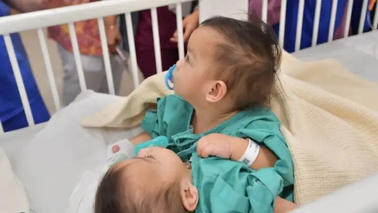 بدء عملية فصل التوأم السيامي أكيزا