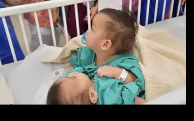 بدء عملية فصل التوأم السيامي أكيزا