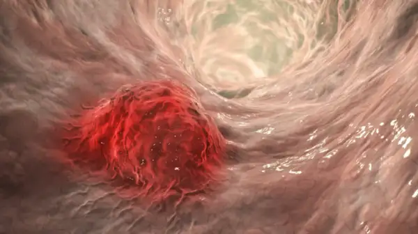 عقار عجيب يذيب الأورام السرطانية