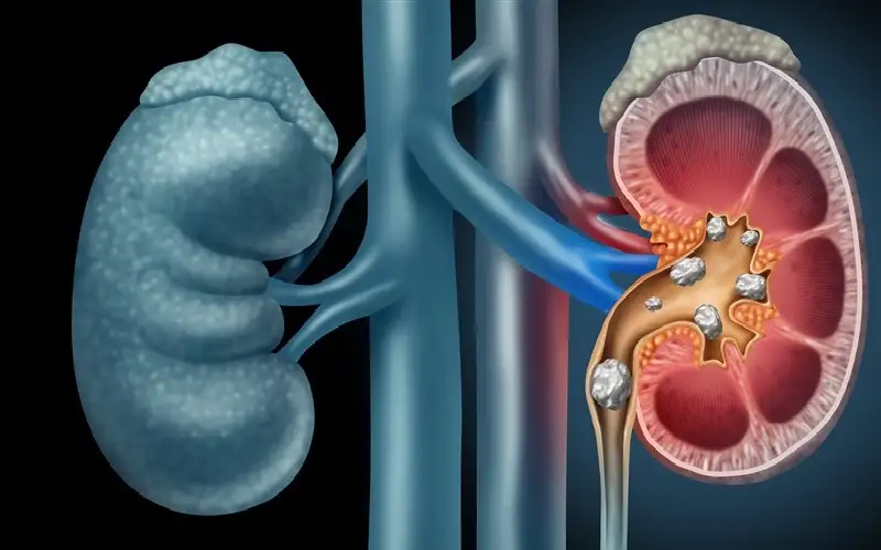 أطعمة يجب تجنبها للوقاية من حصى