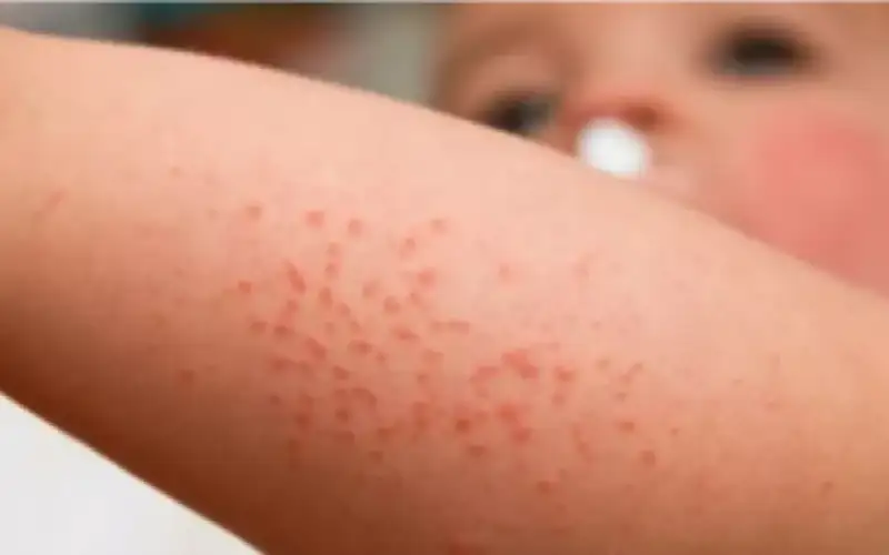 الطفح الحراري ما أسبابه وكيف نعالجه؟