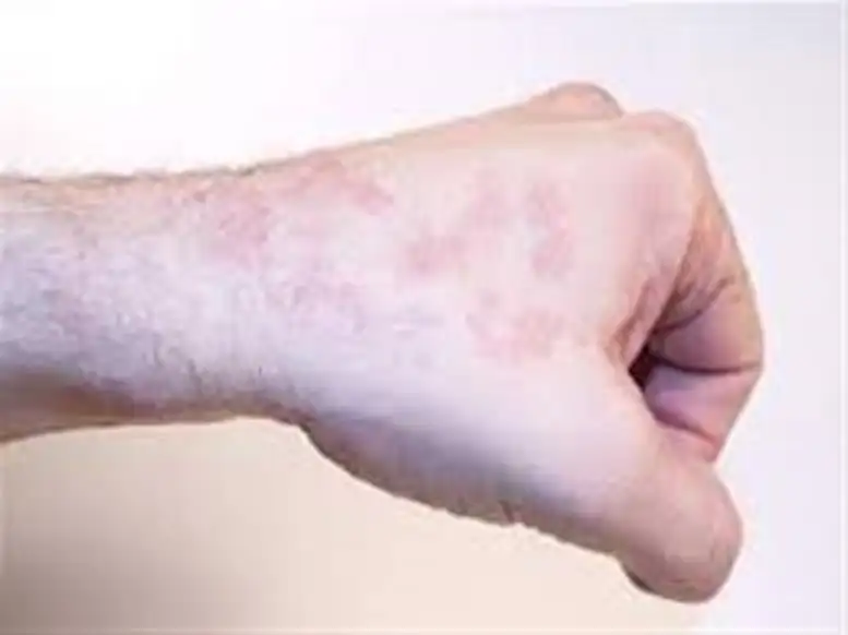 منها سرطان الجلد.. مخاطر الأشعة فوق