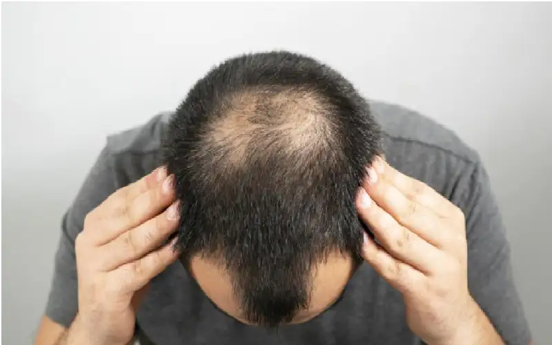 آلية بيولوجية قديمة تتحكم بتساقط الشعر