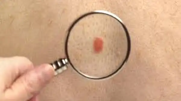 تطوير لقاح جديد يدمر الشامات المسببة