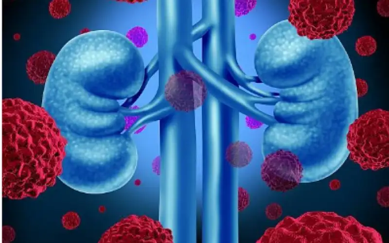 أخصائي أورام يحذر .. اكتشاف 4