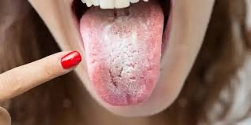 علاج سريع للفطريات في الفم جربيه
