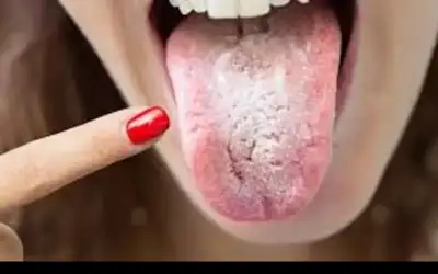علاج سريع للفطريات في الفم جربيه