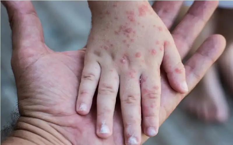 قريبا.. القضاء على أشد الأمراض عدوى