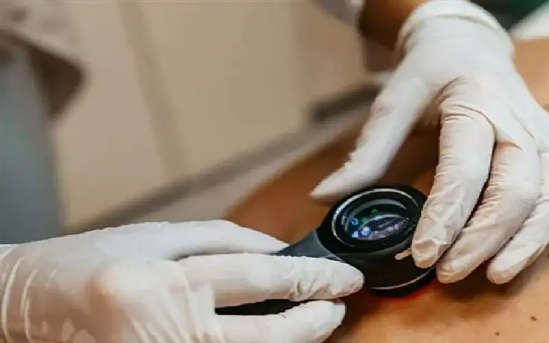 علامة على الجلد تدل على الإصابة