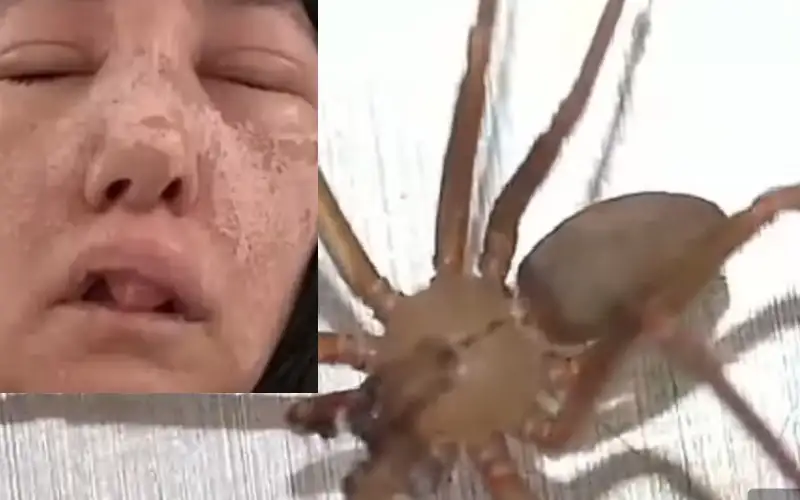 تشوه مرعب لامرأة لدغتها عناكب أثناء