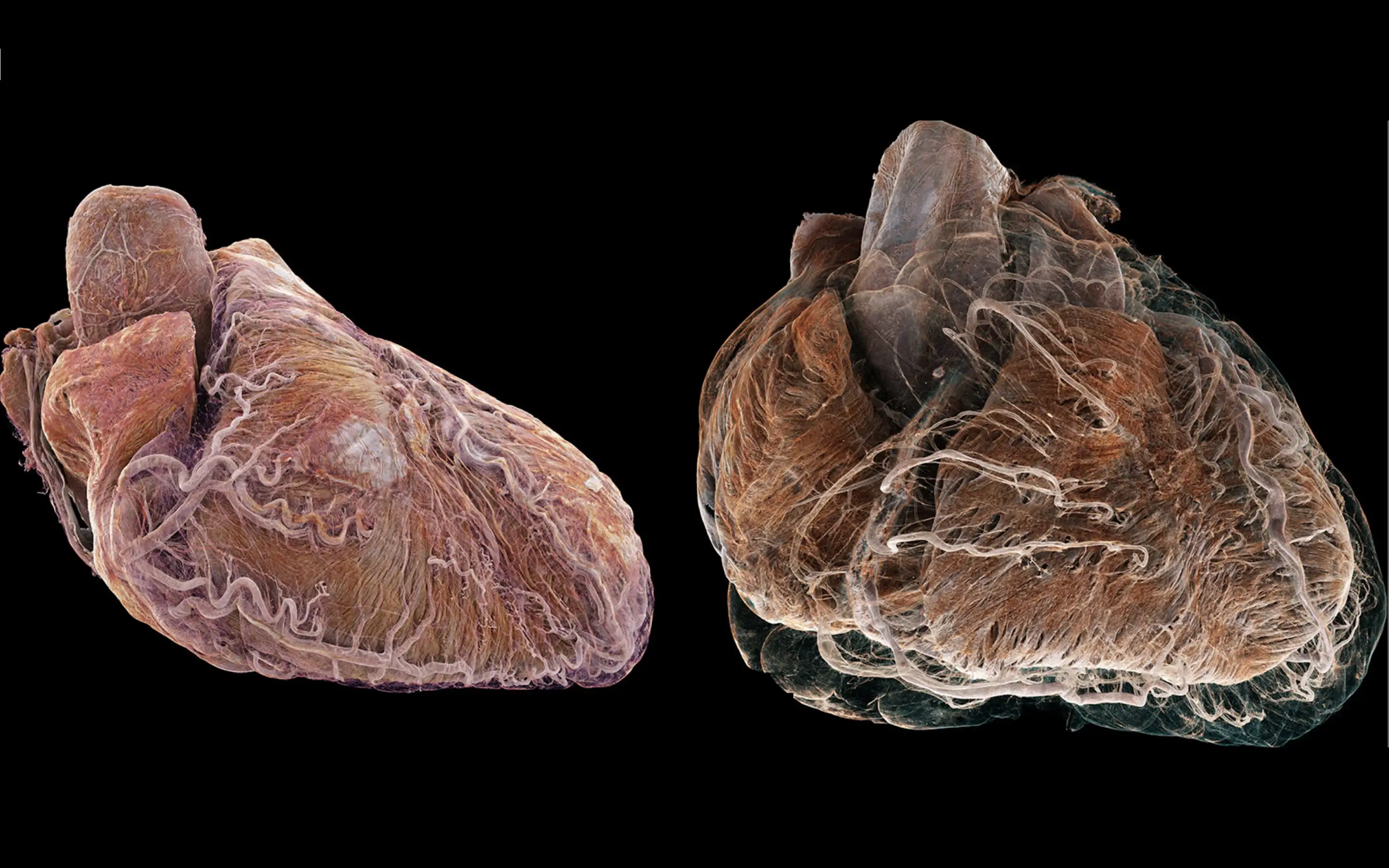 أول صورة ثلاثية الأبعاد لقلبين بشريين