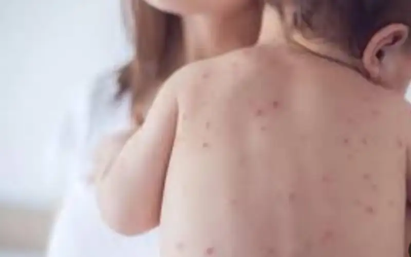 ارتفاع ملحوظ في إصابات جدري الماء