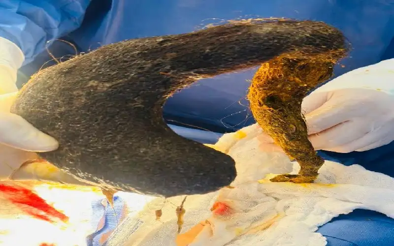 كتلة شعر ضخمة تنمو داخل معدة