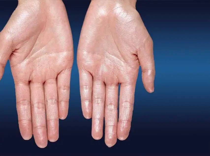 نصائح لمواجهة مشكلة فرط التعرق