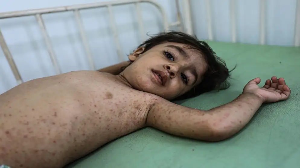 بسبب شح المياه.. أمراض جلدية تفتك