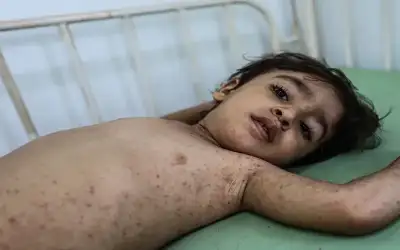 بسبب شح المياه.. أمراض جلدية تفتك