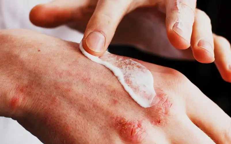 لماذا تتفاقم مشكلة إكزيما البشرة في