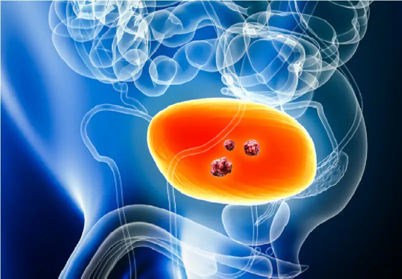 علاقة مفاجئة بين ميكروبات الأمعاء وسرطان