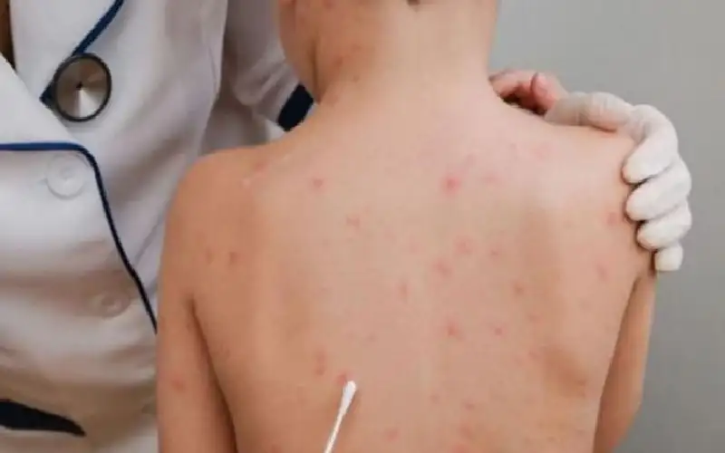 جدري القرود يستنفر العالم.. ترقب لإعلان