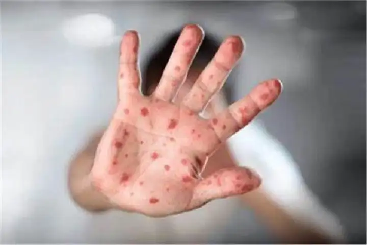 منظمة الصحة العالمية تعقد اجتماعا طارئا