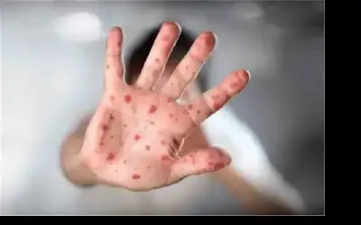 منظمة الصحة العالمية تعقد اجتماعا طارئا