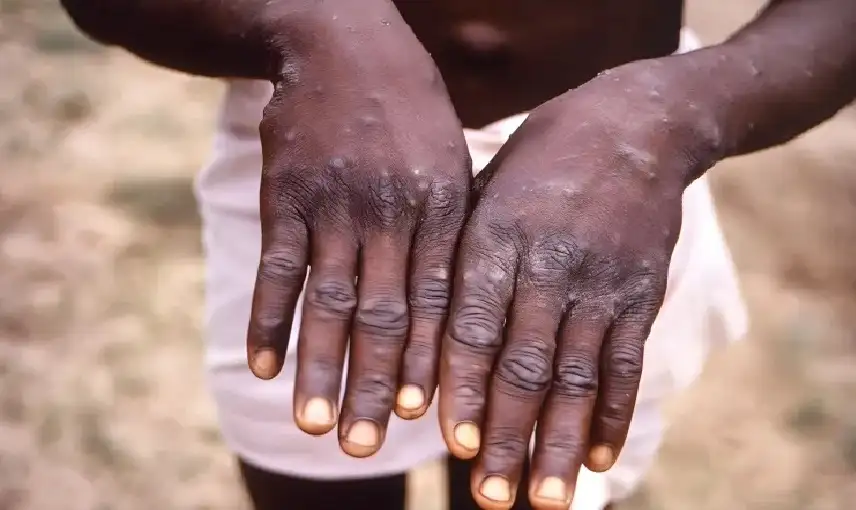 جدري القردة .. كل ما تود