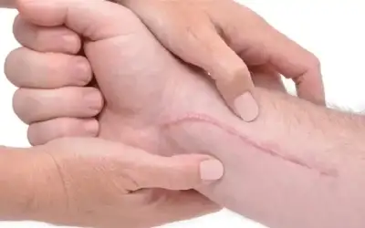 كيف تعتني بالندبات الحديثة؟