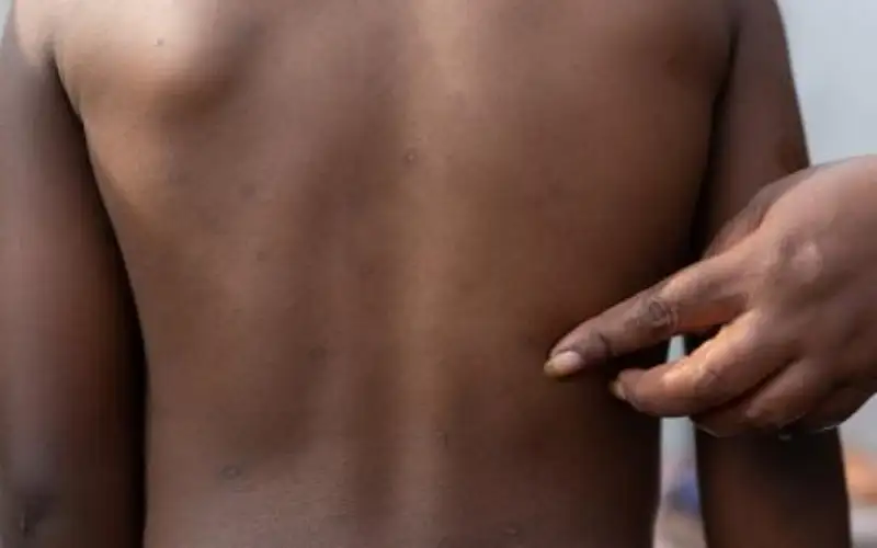 السويد ترصد أول إصابة بالسلالة الجديدة