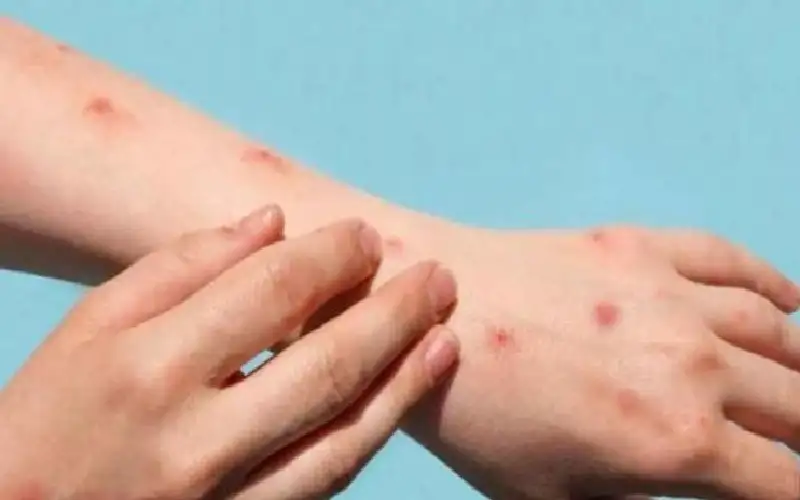 تونس تفعل استراتيجية الوقاية من جدري