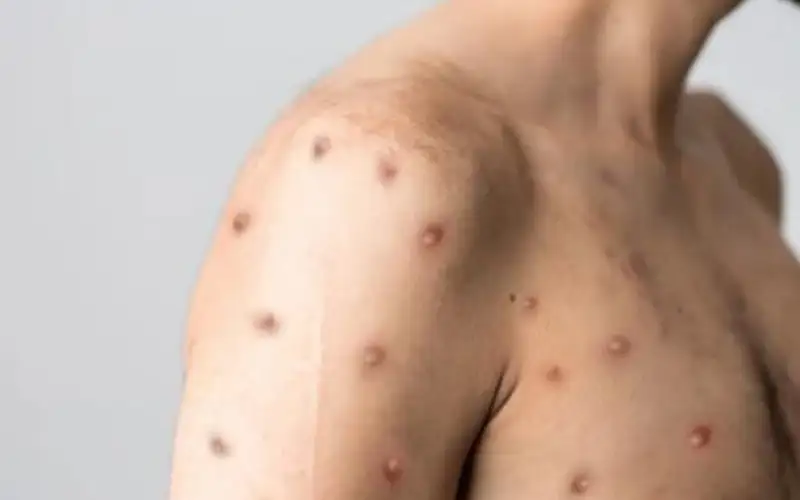 أوروبا ترفع مستوى التأهب لتفشي جدري