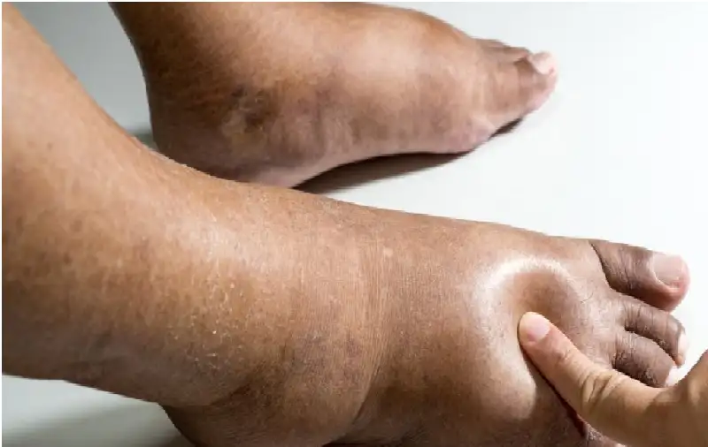 أسباب احتباس السوائل في الجسم