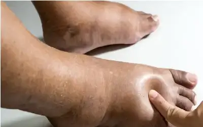 أسباب احتباس السوائل في الجسم