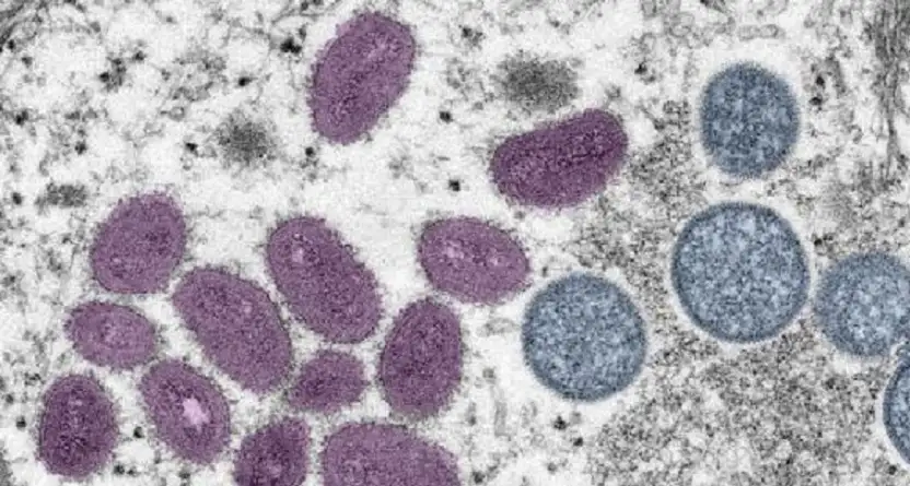 مخاوف جدري القردة تتصاعد