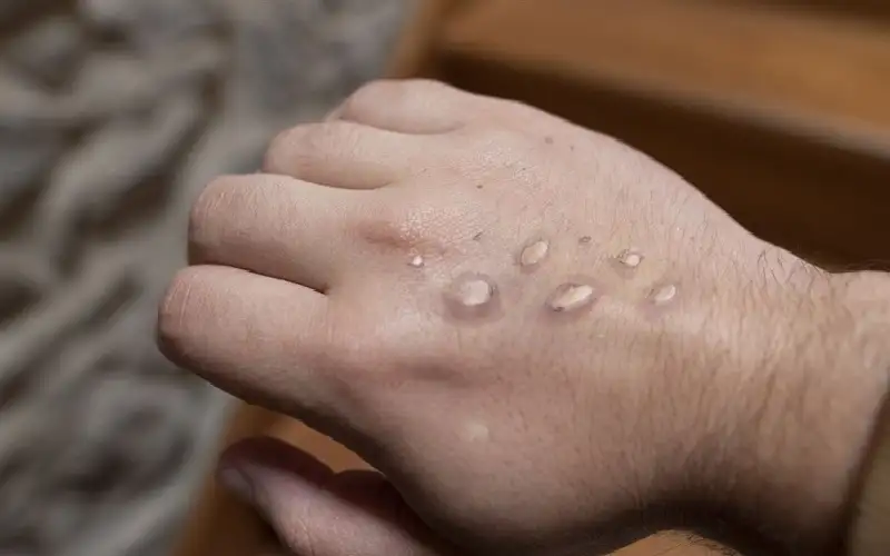 الفلبين ترصد أول إصابة بجدري القردة