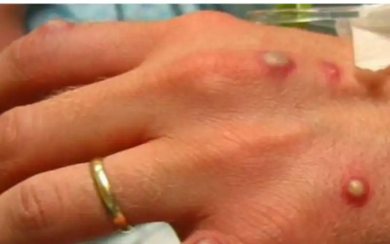 رصد أول حالة وافدة من جدري