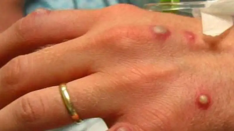 رصد أول حالة وافدة من جدري