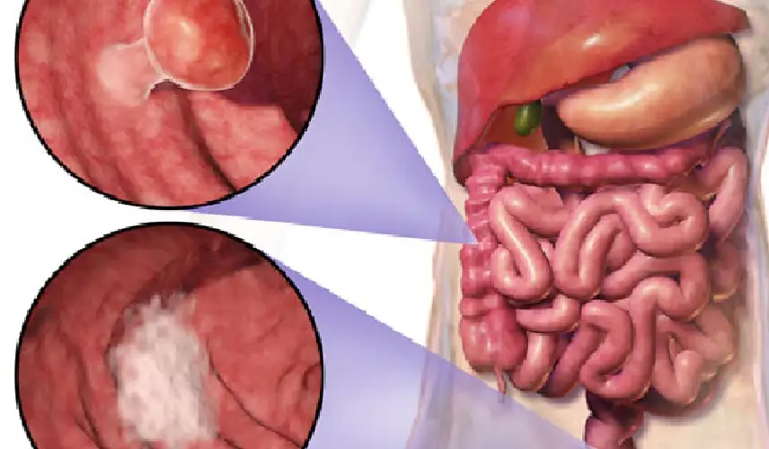 ارتفاع إصابة الشباب النحفاء فائقي اللياقة