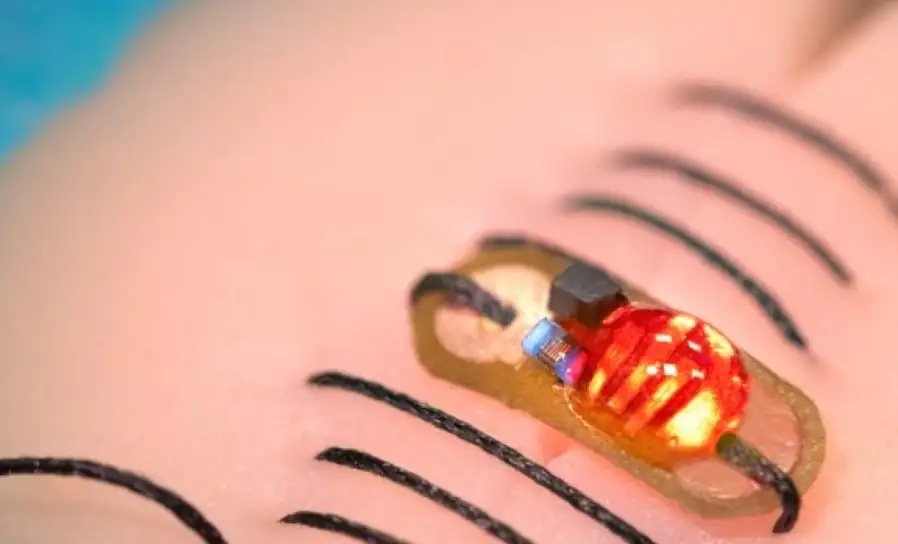 خياطة إلكترونية ذكية تراقب التهاب الجروح