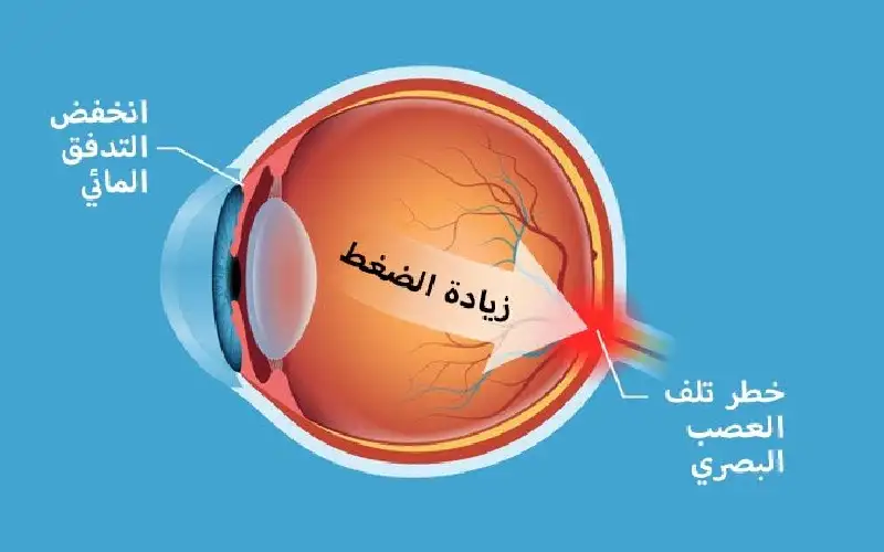 أعراض ضغط العين.. وفي هذه الحالات