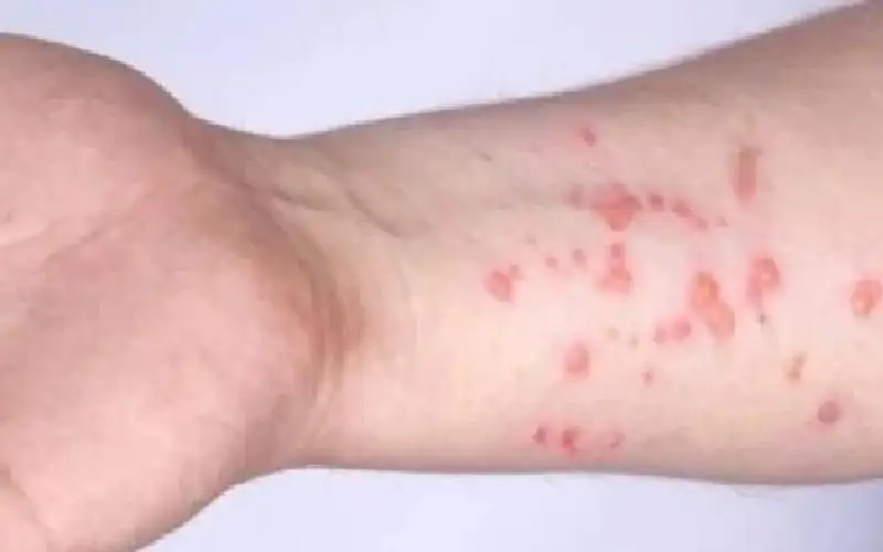 جدري القرود يواصل انتشاره.. إصابات جديدة